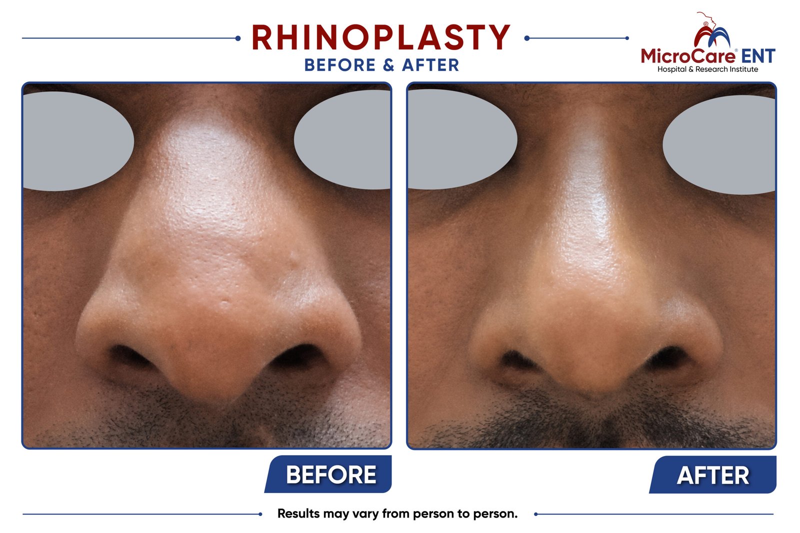 Before and after open rhinoplasty in Hyderabad showing a male patient with a wide irregular nasal dorsum, irregular bridge, and broad under-projected nasal tip corrected to a narrow straight dorsum with a refined, well-projected nasal tip following surgery at MicroCare ENT.