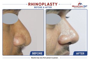 Before and after open rhinoplasty in Hyderabad showing a male patient with a droopy nasal tip and broad supratip area corrected to a well-projected nasal tip with a refined, narrow supratip and balanced nasal profile following surgery at MicroCare ENT.