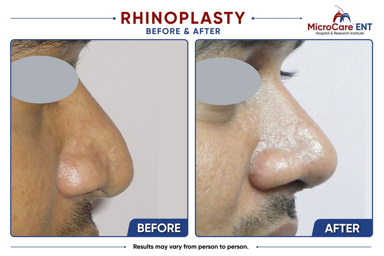 Before and after open rhinoplasty in Hyderabad showing a male patient with a droopy nasal tip and broad supratip area corrected to a well-projected nasal tip with a refined, narrow supratip and balanced nasal profile following surgery at MicroCare ENT.