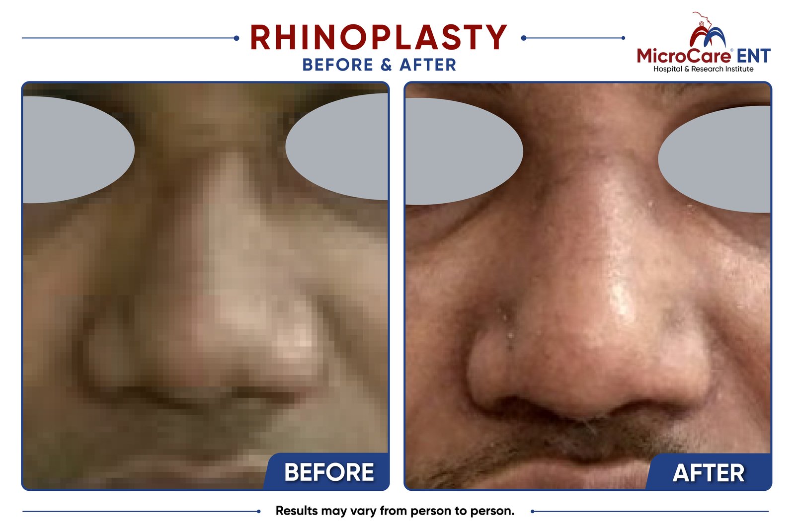 Rhinoplasty before and after at MicroCare ENT, Hyderabad: patient result