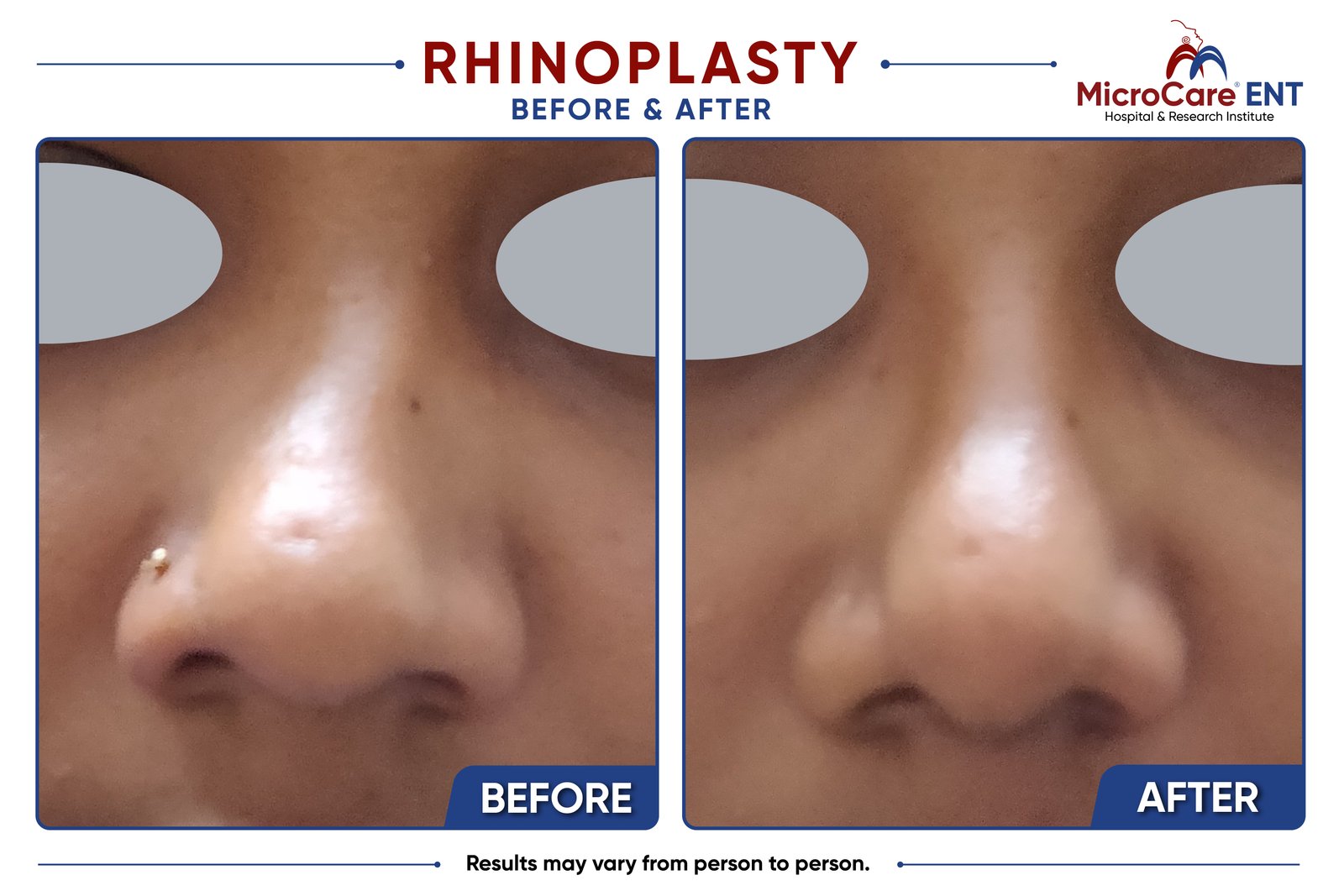 Rhinoplasty before and after at MicroCare ENT, Hyderabad: patient result