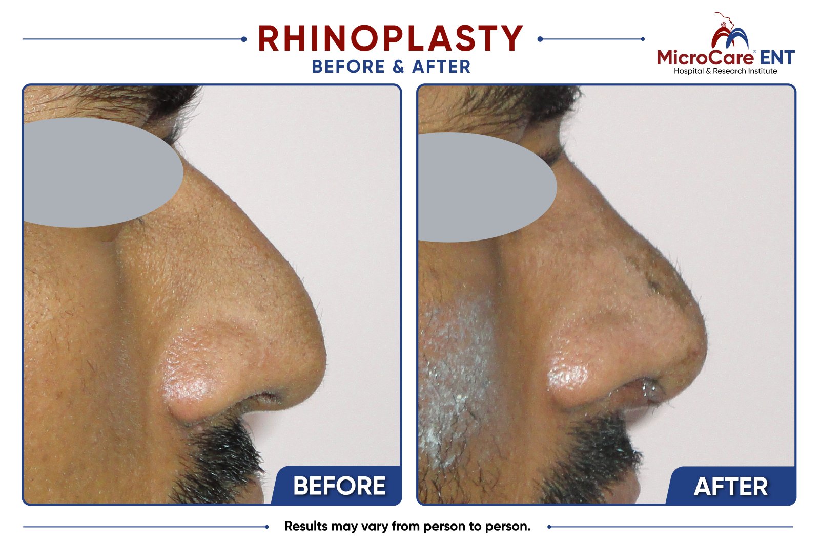 Rhinoplasty before and after at MicroCare ENT, Hyderabad: patient result