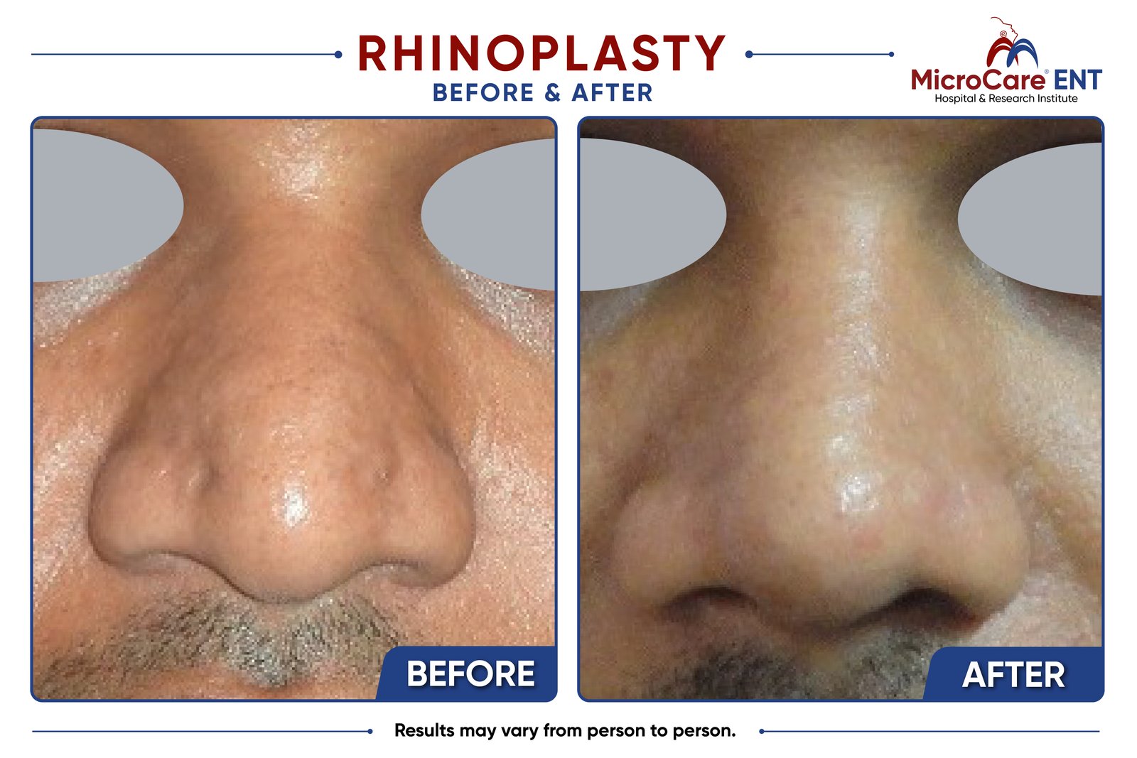 Rhinoplasty before and after at MicroCare ENT, Hyderabad: patient result