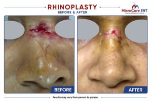 Before and after closed rhinoplasty in Hyderabad showing a female patient with multiple nasal bone fractures corrected to a straight, narrow nasal dorsum following surgery at MicroCare ENT.