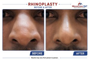 rhinoplasty frame-01