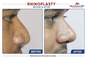 rhinoplasty frame-02