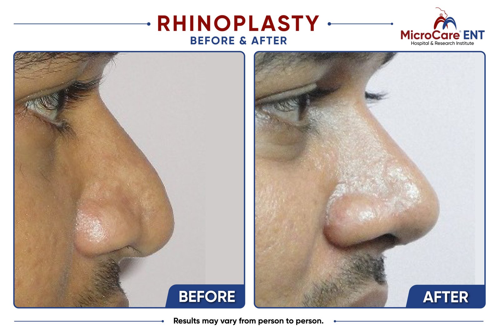 rhinoplasty frame-02