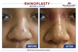 rhinoplasty frame-03