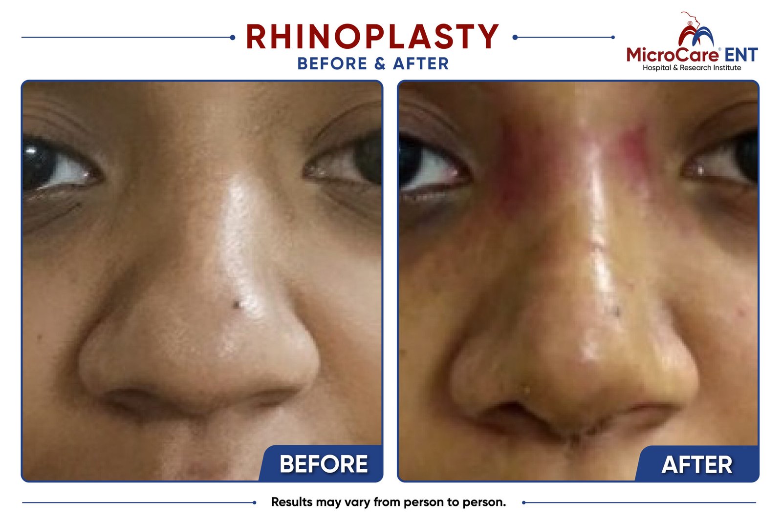 rhinoplasty frame-03