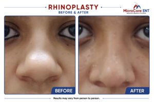 rhinoplasty frame-04