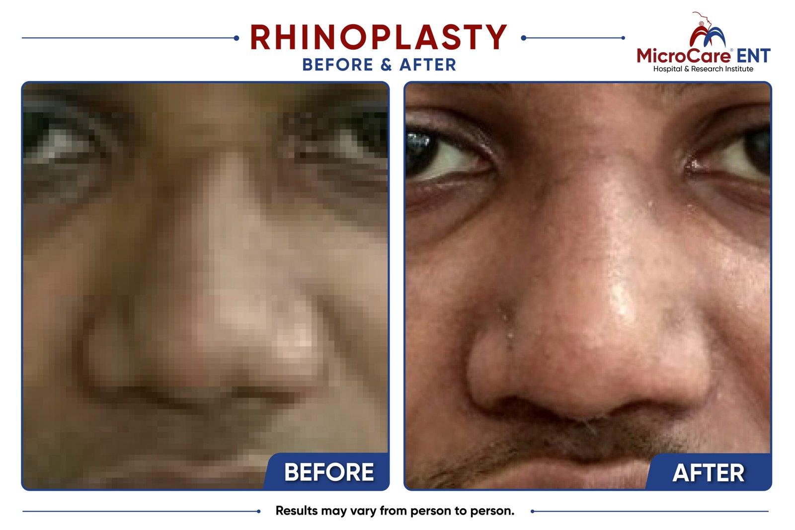 rhinoplasty frame-05