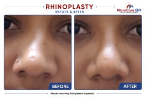 rhinoplasty frame-06
