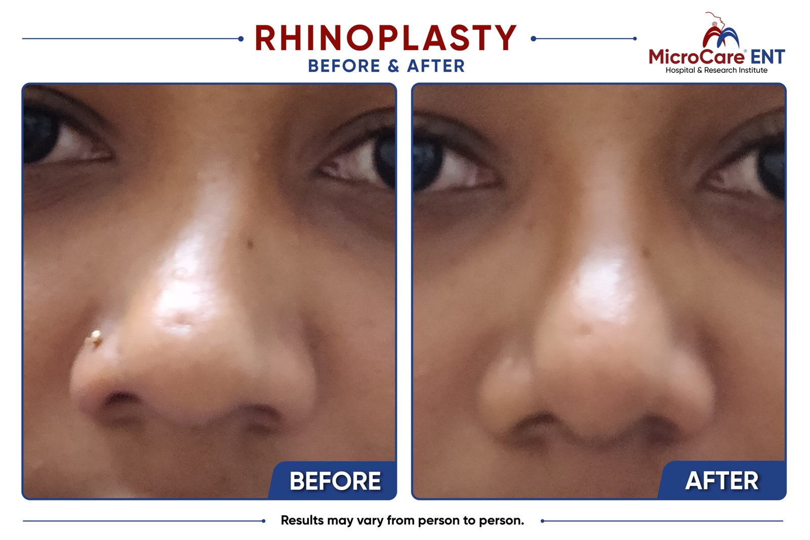rhinoplasty frame-06