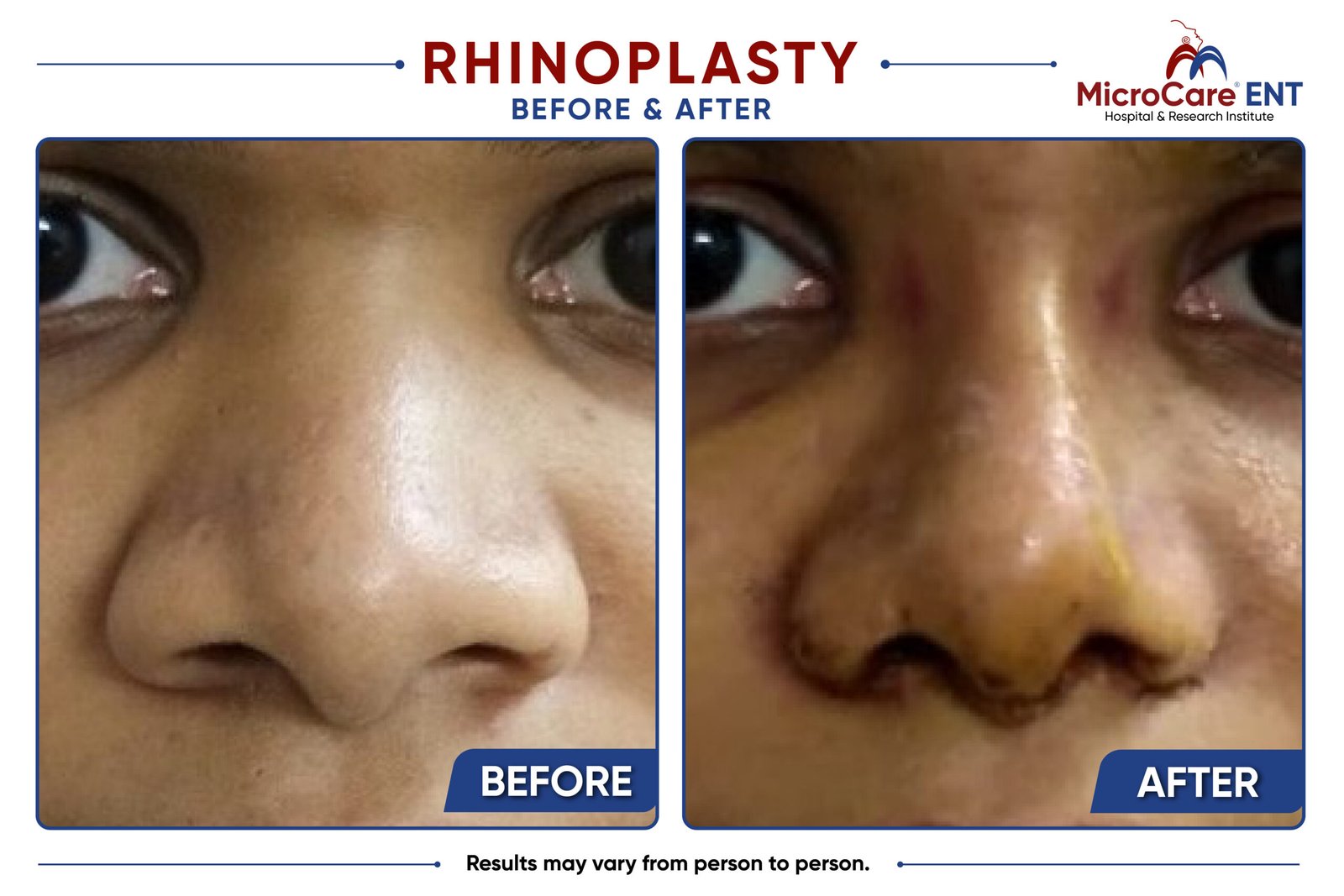 rhinoplasty frame-07