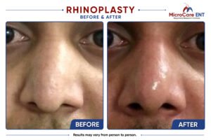rhinoplasty frame-08
