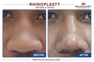 rhinoplasty frame-09