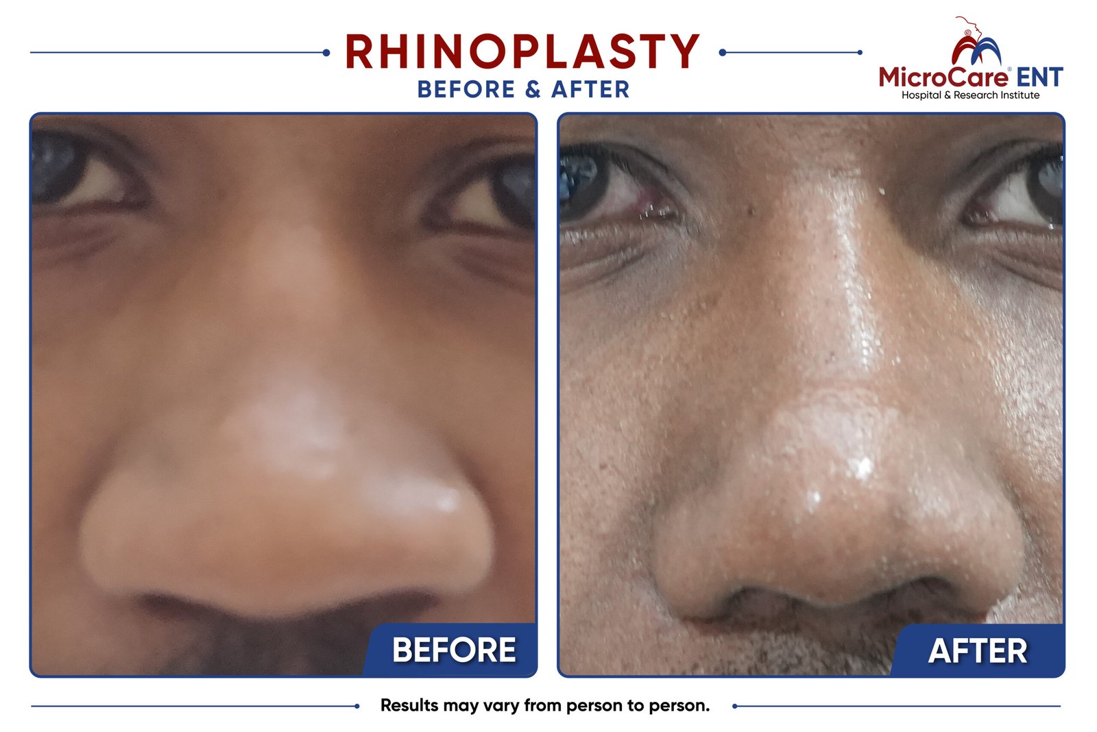 rhinoplasty frame-09