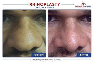 rhinoplasty frame-10