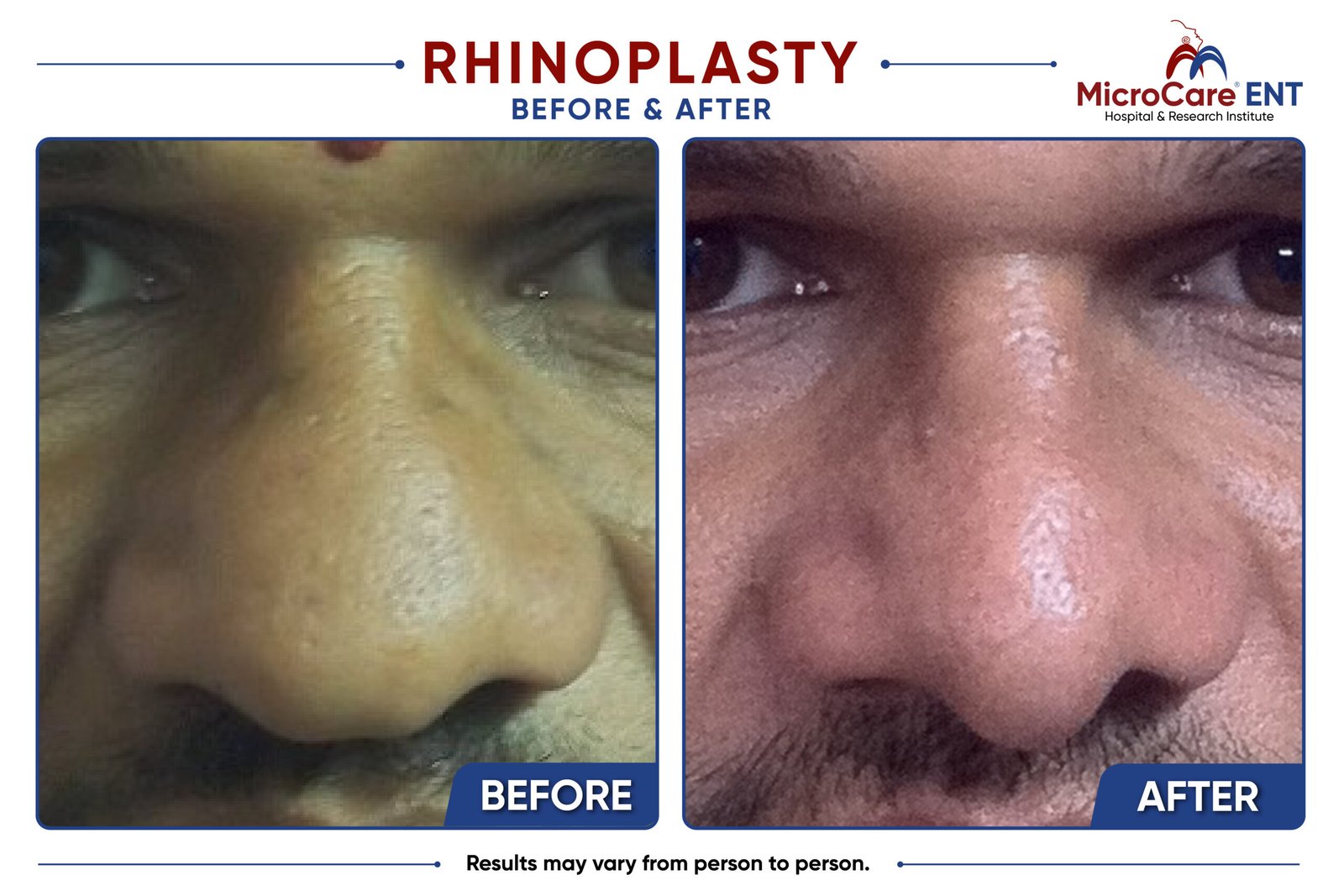 rhinoplasty frame-10