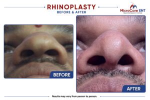 rhinoplasty frame-11