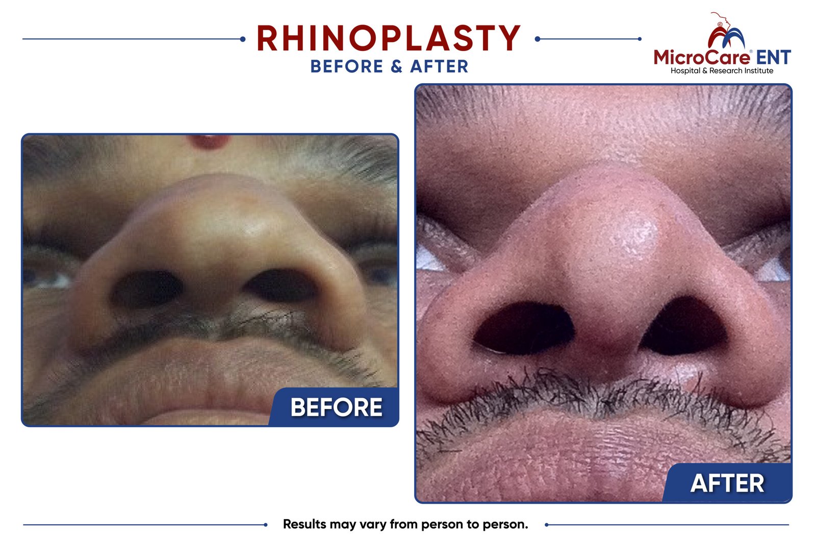 rhinoplasty frame-11