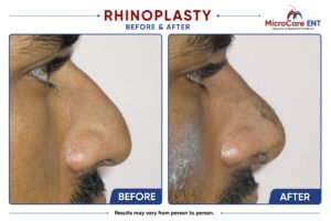 rhinoplasty frame-12