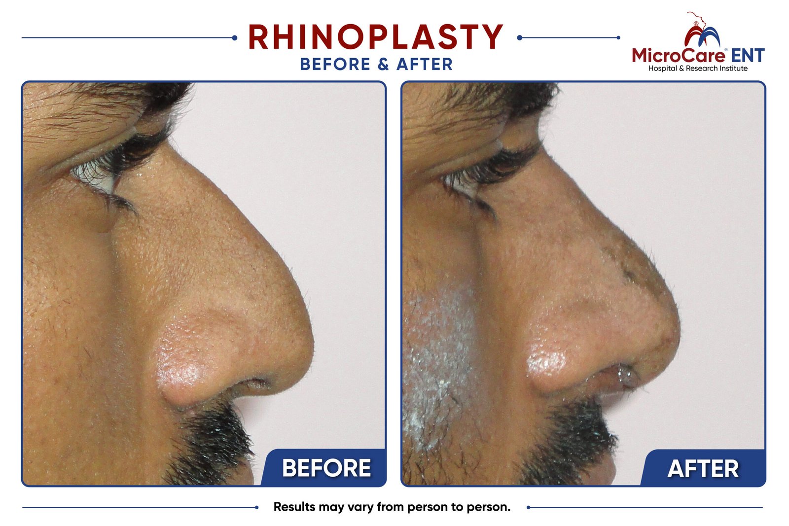 rhinoplasty frame-12