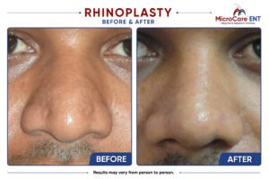 rhinoplasty frame-13