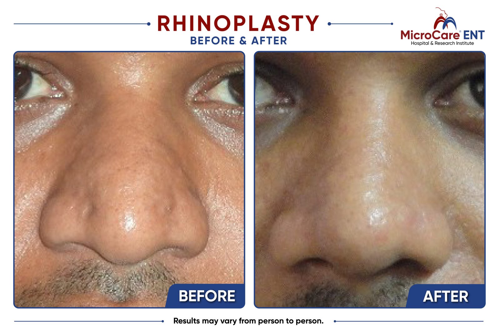 rhinoplasty frame-13