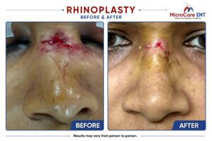 rhinoplasty frame-14