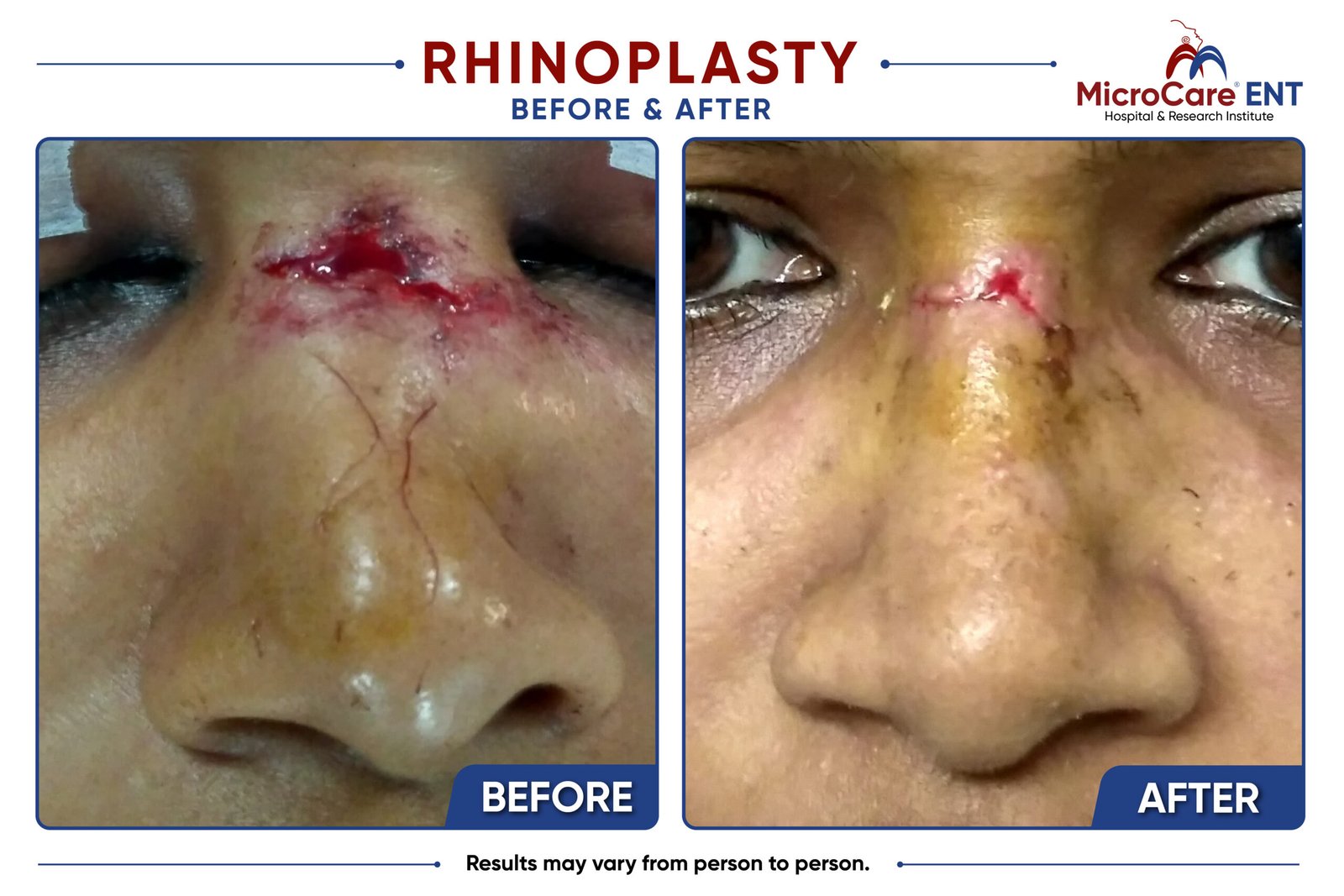 rhinoplasty frame-14