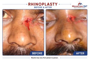 rhinoplasty frame-15